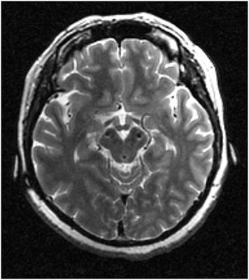 Variable High-Frequency Deep Brain Stimulation of the Subthalamic Nucleus for Speech Disorders in Parkinson's Disease: A Case Report